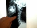 Huntington Beach Chiropractor Has Natural Pain Relief Solut