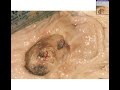 Histopathology Small intestine, duodenum --Chronic peptic ul Histopathology Small intestine, duodenum --Chronic peptic ul