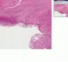 Histopathology Small intestine, duodenum --Chronic peptic ul