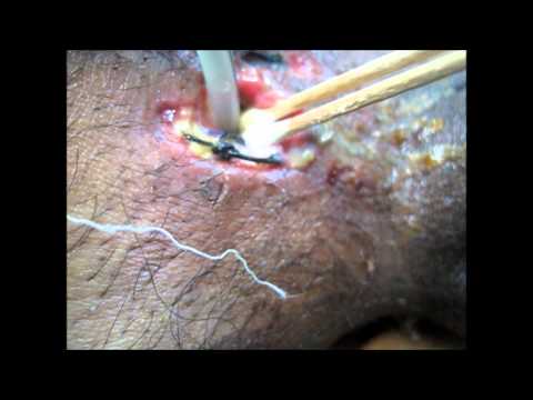 how to obtain wound culture