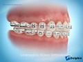 Correcting Dental Asymmetries Using Rubber Bands