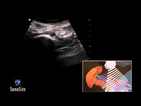 how to perform aortic ultrasound