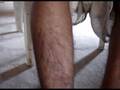 LEPRA Society ARTH -Self-care Management.divx