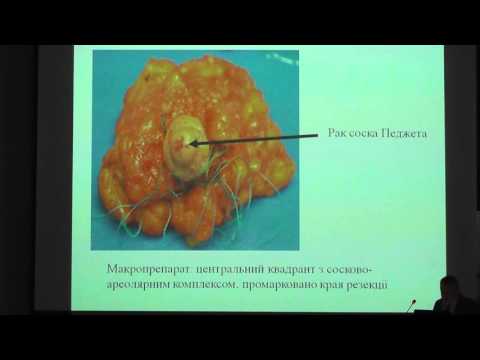 Доклад хирурга Национального института рака Олега Сидорчука «Техника Гризотти в органосохраняющей хирургии рака молочной железы». Украина.