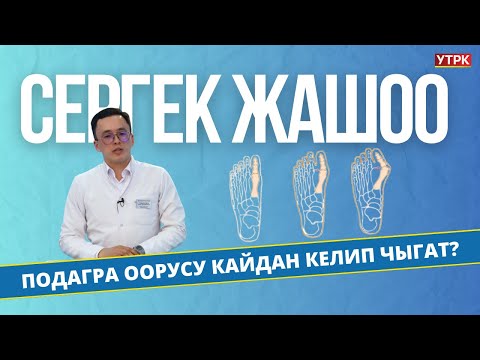 Подагра оорусу кайдан келип чыгат? | Сергек жашоо