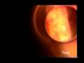 videos de Laser Suture Lysis after Trabeculectomy