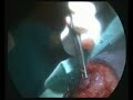 Laparoscopic assisted gastropexy in a dog
