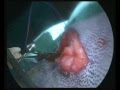 videos de Laparoscopic assisted gastropexy in a dog