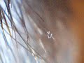 must see moving morgellons disease organism must see