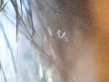 MUST SEE Moving Morgellons disease organism MUST SEE MUST SEE Moving Morgellons disease organism MUST SEE