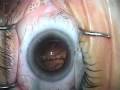 Modern Cataract Surgery, vol. 4 with ReSTOR IOL