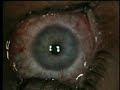 lasik surgery lasik surgery