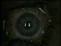 Lasik eye surgery video