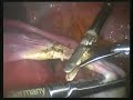 Htl en útero grande con cesarea previa (2)