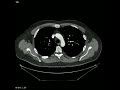 CT scan of saddle pulmonary embolism Pulmonary Embolism