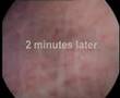 Interstitial Cystitis Cystoscopy interstitialcystitis.org.uk