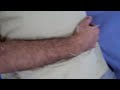 Accupuncture Accupuncture