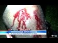 ABC Exclusive: New Photo Shows Zimmerman's Bloody Head Injuries