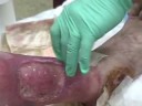 maggot therapy 3