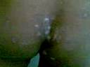 Scabies and Tenia Capitis Scabies and Tenia Capitis