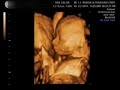 23rd week 4D Ultrasound - Amazing! 23rd week 4D Ultrasound - Amazing!