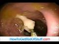 videos de Pesky Tapeworms