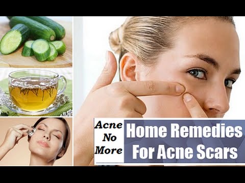 how to treat a newborn acne