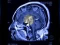 Doctors Use 3-D For Surgery