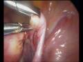 ectopic pregnancy,laparoscopic salpingectomy