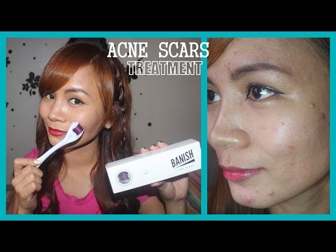 how to use a dermaroller for acne scars