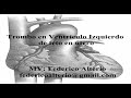 Trombo en ventriculo izquierdo en feto