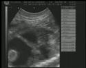 Trombo en ventriculo izquierdo en feto