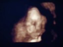 Chloe's First Video (3D Sonogram) Part 2