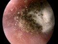 Otomycosis
