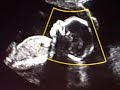 baby-parker-20-weeks.html