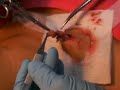 Sebaceous Cyst being excised by Dr. VIlla (Medical Mission)