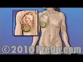 PreOp® Educación del Paciente La mastectomía total Cirugía de los Senos