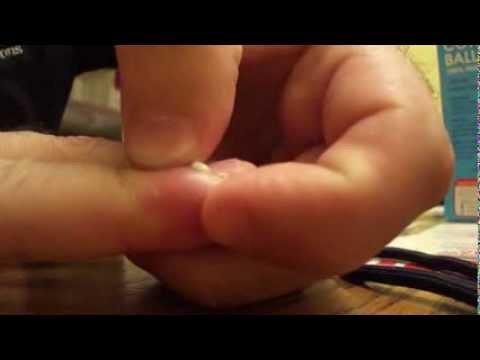 how to cure hangnails