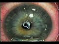 OptiVision-LASIK Laser Vision Correction Procedure-Wisconsin OptiVision-LASIK Laser Vision Correction Procedure-Wisconsin