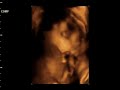 3D-Ultraschallvideo4