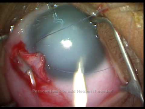 micro catheter -