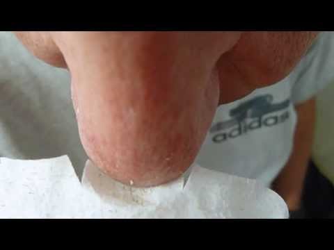 how to unclog leg pores