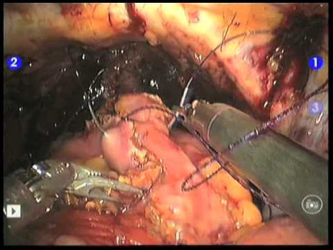 how to cure lymphocele