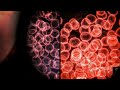 RVU WiseBits: Chemo