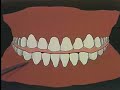 Construction of an Occlusal Bite Splint