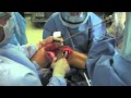 Distal End Femur Lump Total Excision With Prosthesis Insertion Distal End Femur Lump Total Excision With Prosthesis Insertion