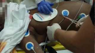 Two Cardiac Arrests