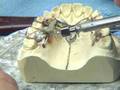 2008 IPC Distalizer