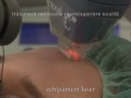 Tratamentul de reintinerire cutanata (lasere, IPL, Accent, Duolith)