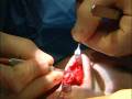 videos de Rhinoplasty